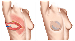 ricostruzione della mammella dopo Mastectomia